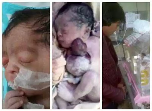 OMG! Baby Girl Born With Her Heart Outside Her Chest [Graphic Photos]